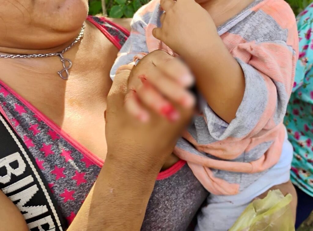 Bebé se le desprende parte de su dedo en Kanasín 